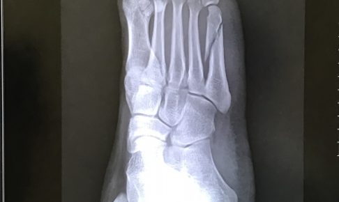 骨折